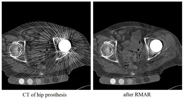 wxDicom Refined Metal Artefact Reduction