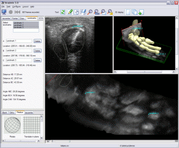 Structure of a talipes foot in 3D