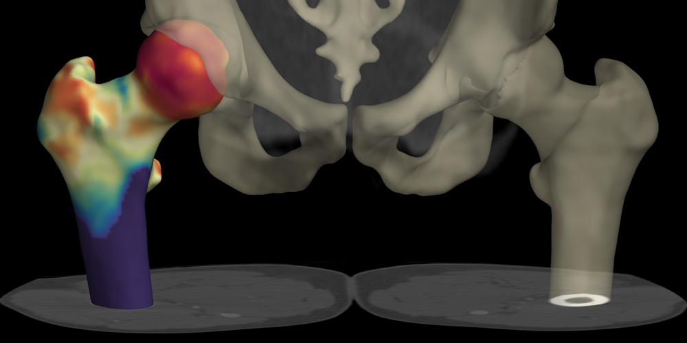 Cortical Bone Mapping visualisation